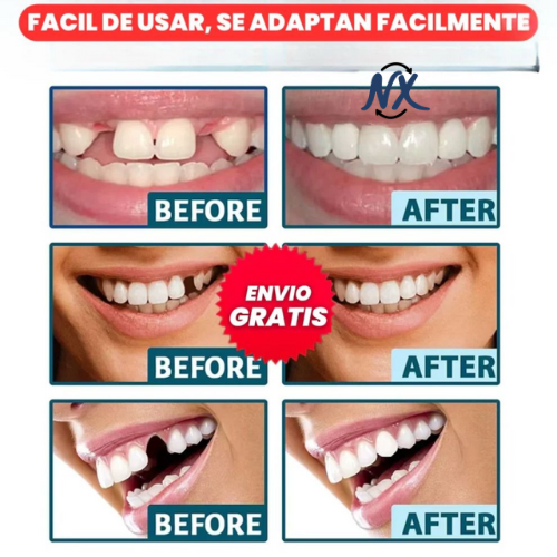 Carillas Dentales Ajustables, Dientes de Ceramica | Snapon Smile™